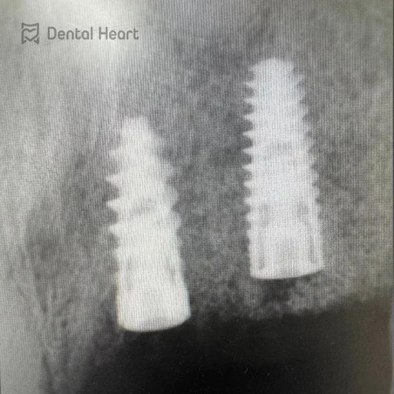 Ordinace Dental Heart – implantace 12