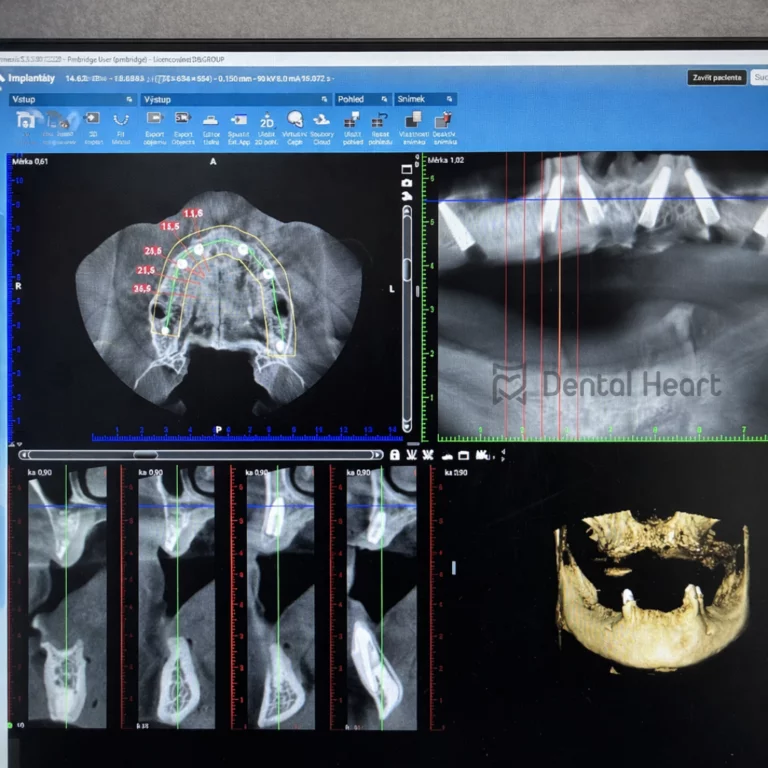 Ordinace Dental Heart – implantace 6
