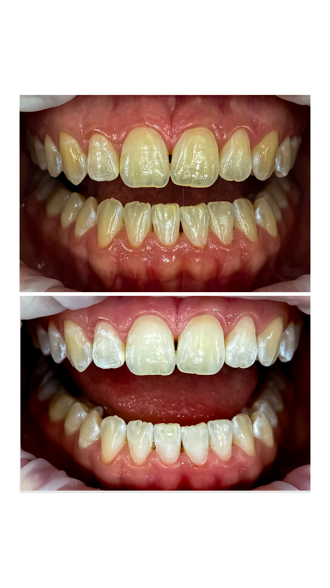 Zuby před a po ordinačním bělení — pacient Dental Heart