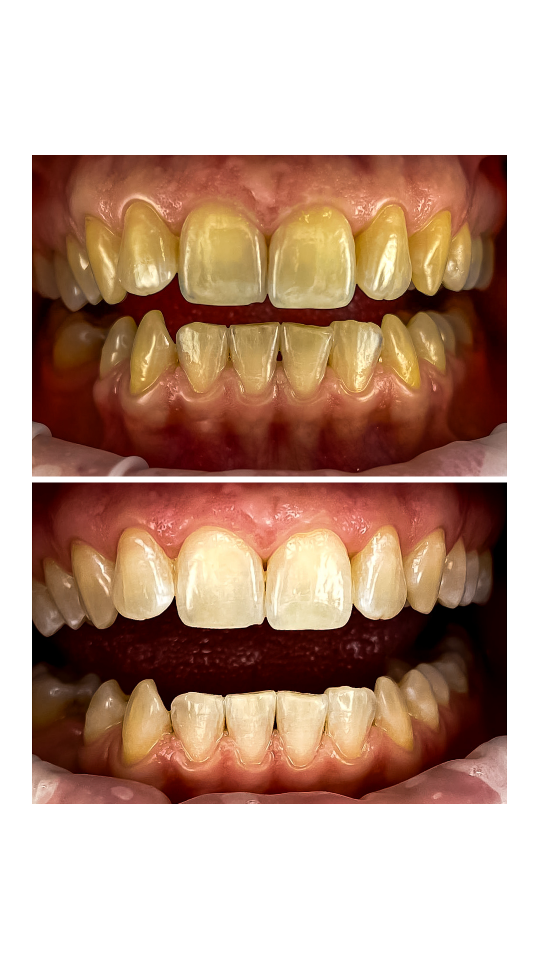 Zuby před a po ordinačním bělení — pacient Dental Heart