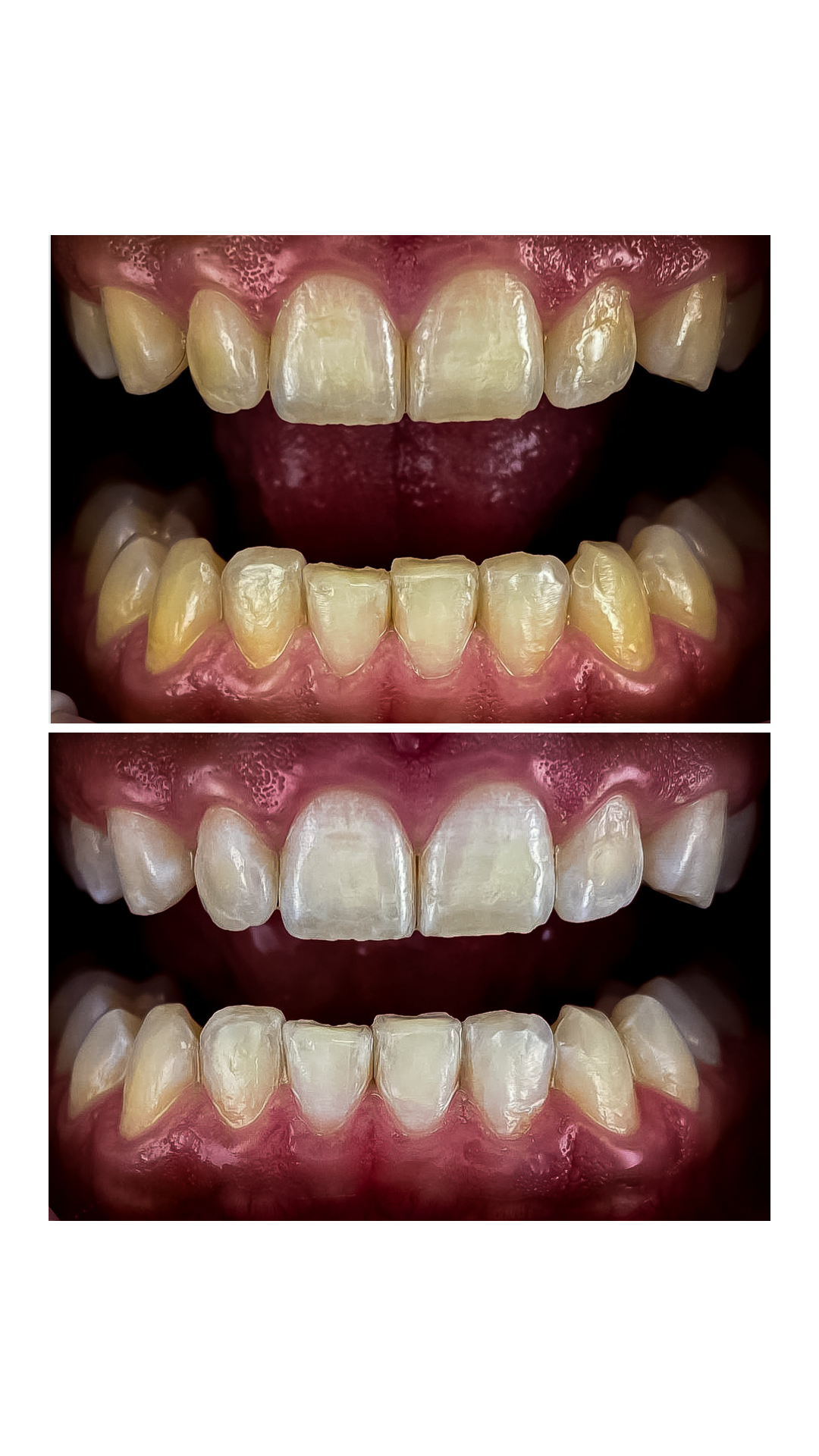 Zuby před a po ordinačním bělení — pacient Dental Heart