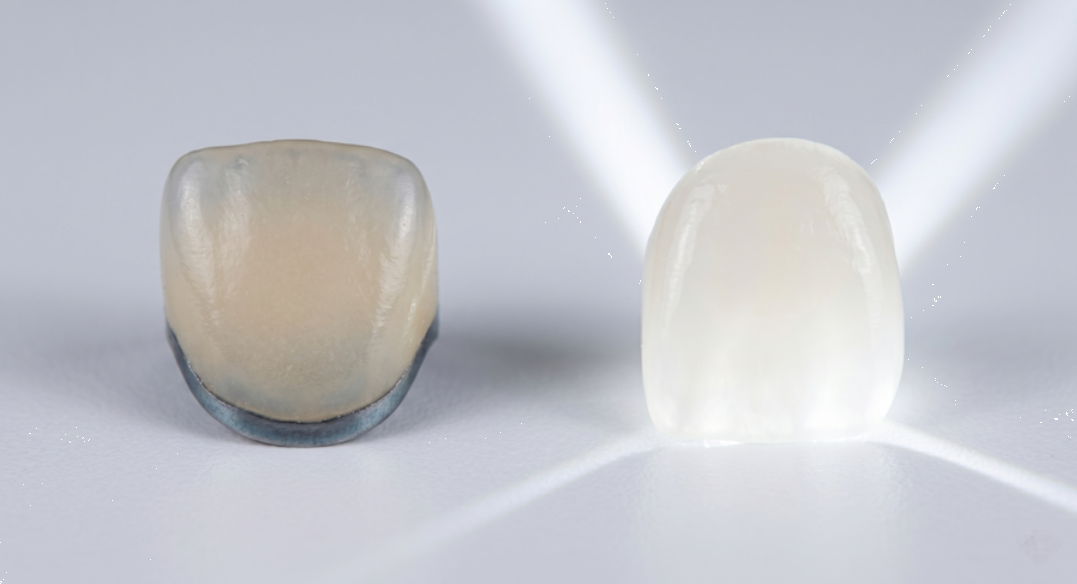 Vizuální_srovnání_metalokeramická_korunka_сelokeramická_zirkonová_korunka