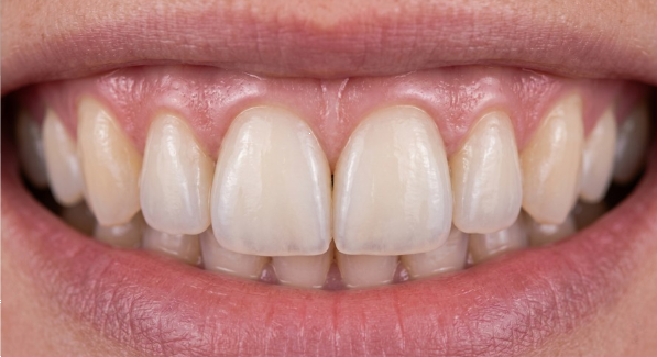 Zirkonové korunky na předních řezácích s přirozenou transparencí a přesným přilehnutím k dásni, klinika Dental Heart