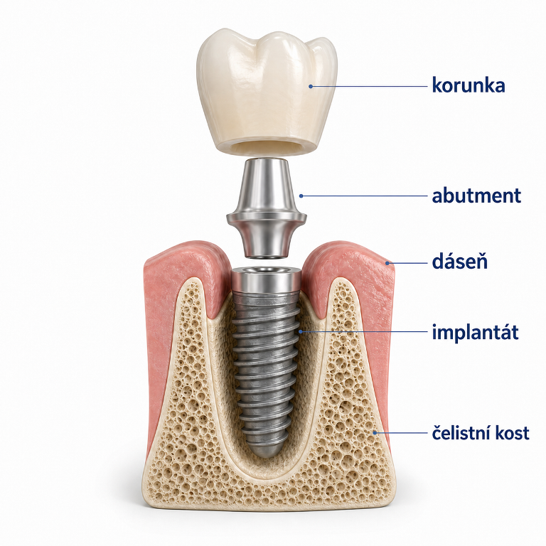 Části zubního implantátu – implantát, abutment a korunka
