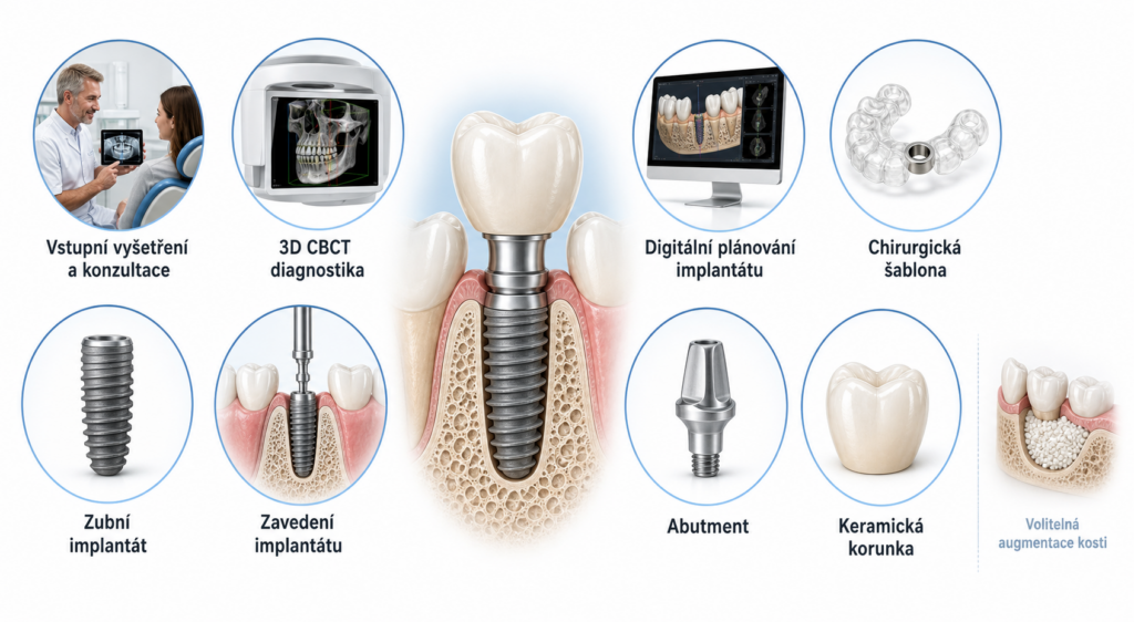 Co tvoří celkovou cenu zubního implantátu