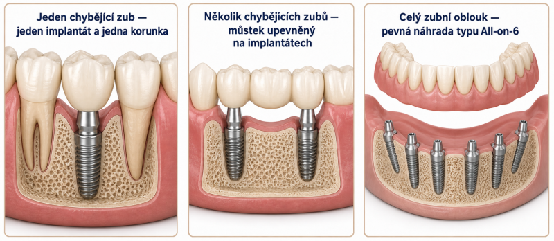 Možnosti náhrady jednoho, několika nebo všech zubů implantáty