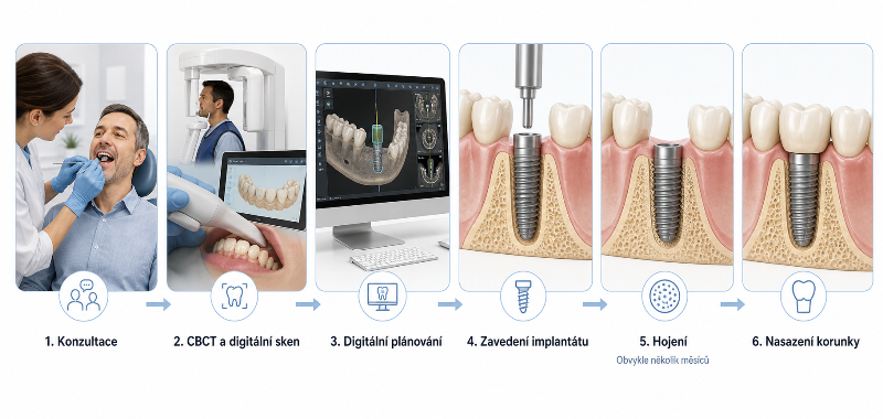 Průběh implantace zubu od konzultace po nasazení korunky