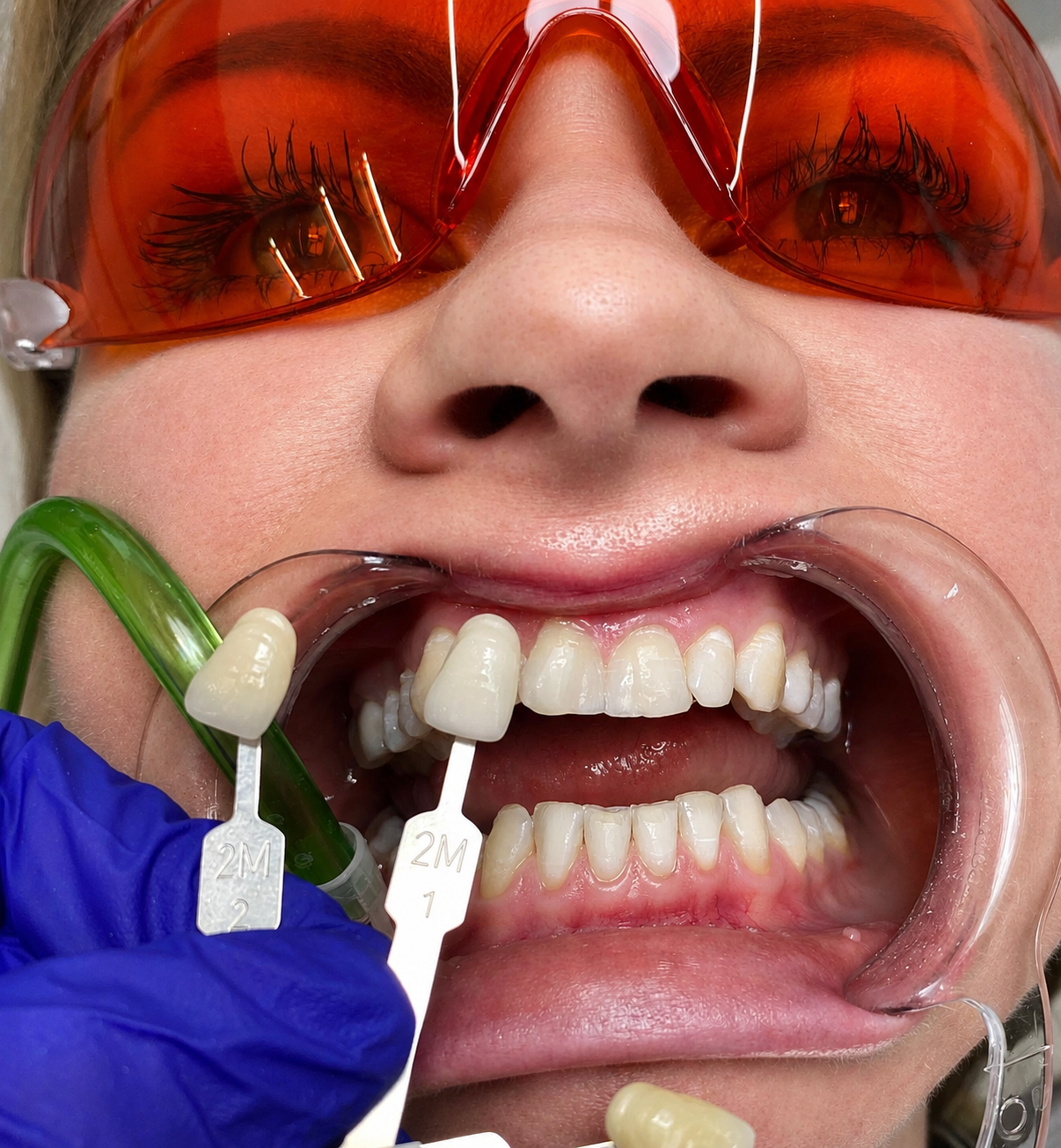 Výsledek ordinačního bělení zubů v Dental Heart